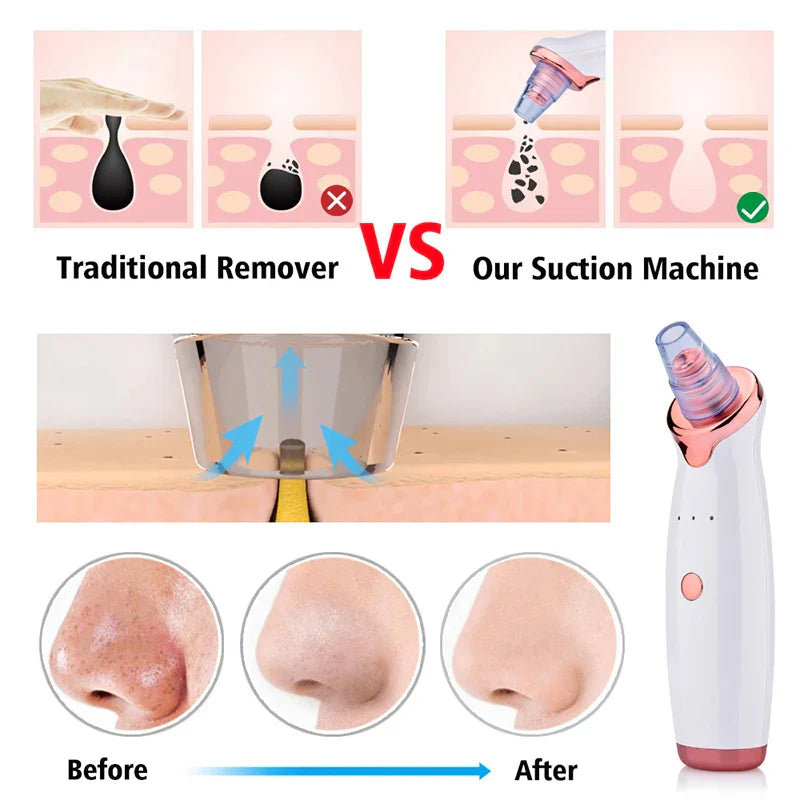 5 in 1 Multifunctional Blackhead Remover (Rechargeable)