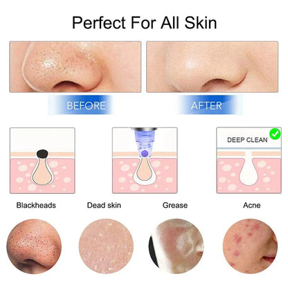 5 in 1 Multifunctional Blackhead Remover (Rechargeable)